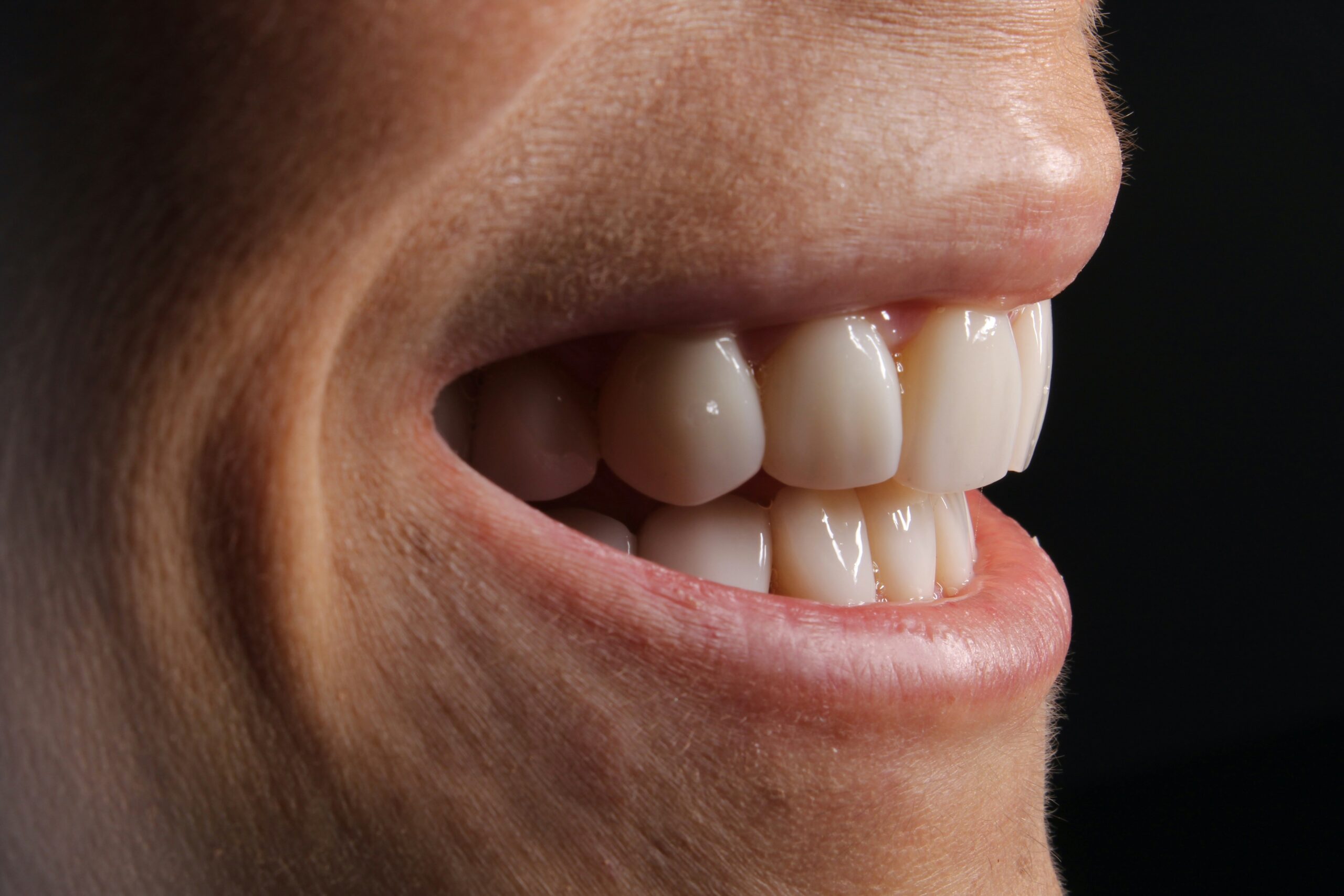 Veneers near me