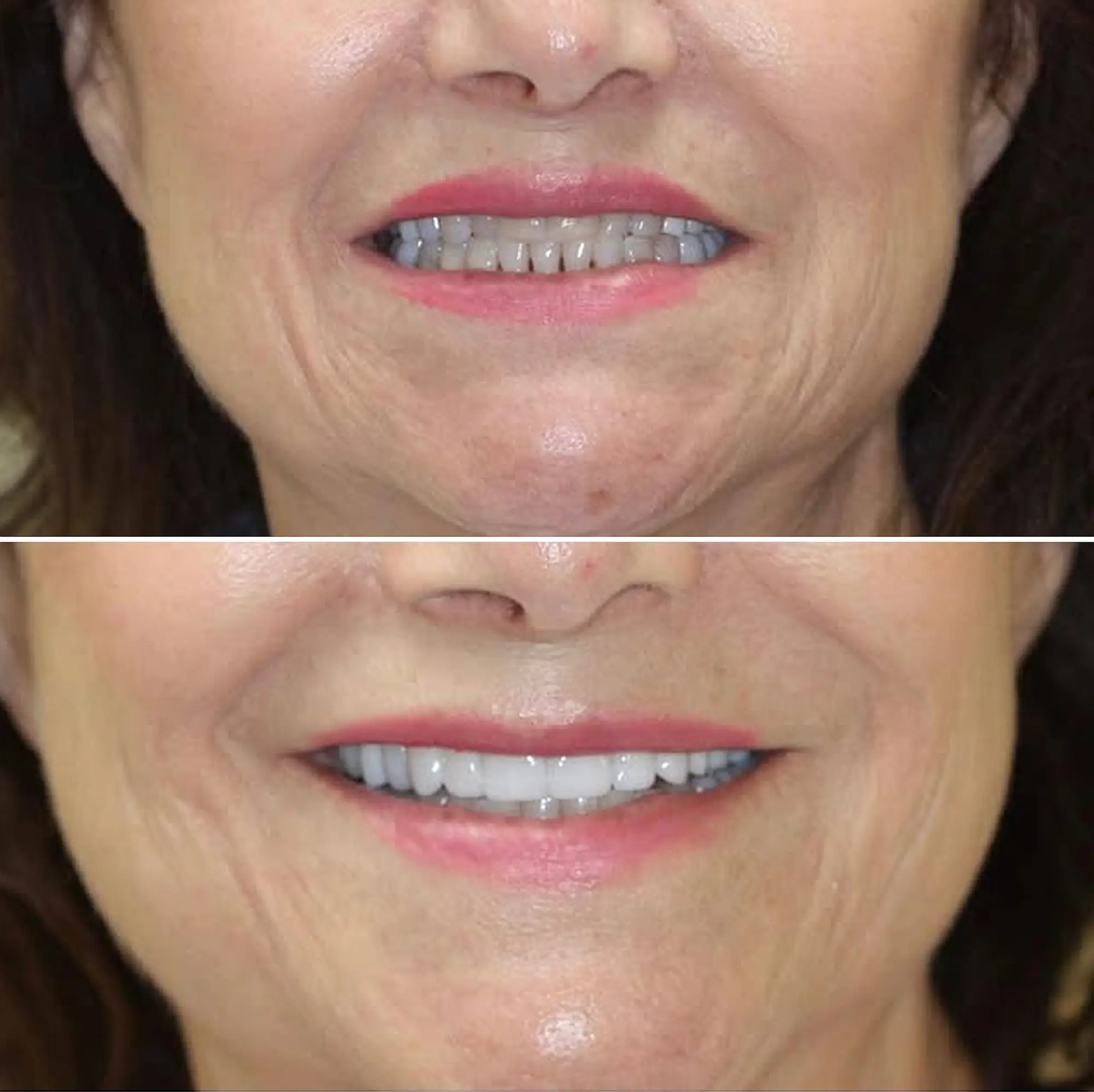 Before and after smile transformation showing improved tooth color and alignment.