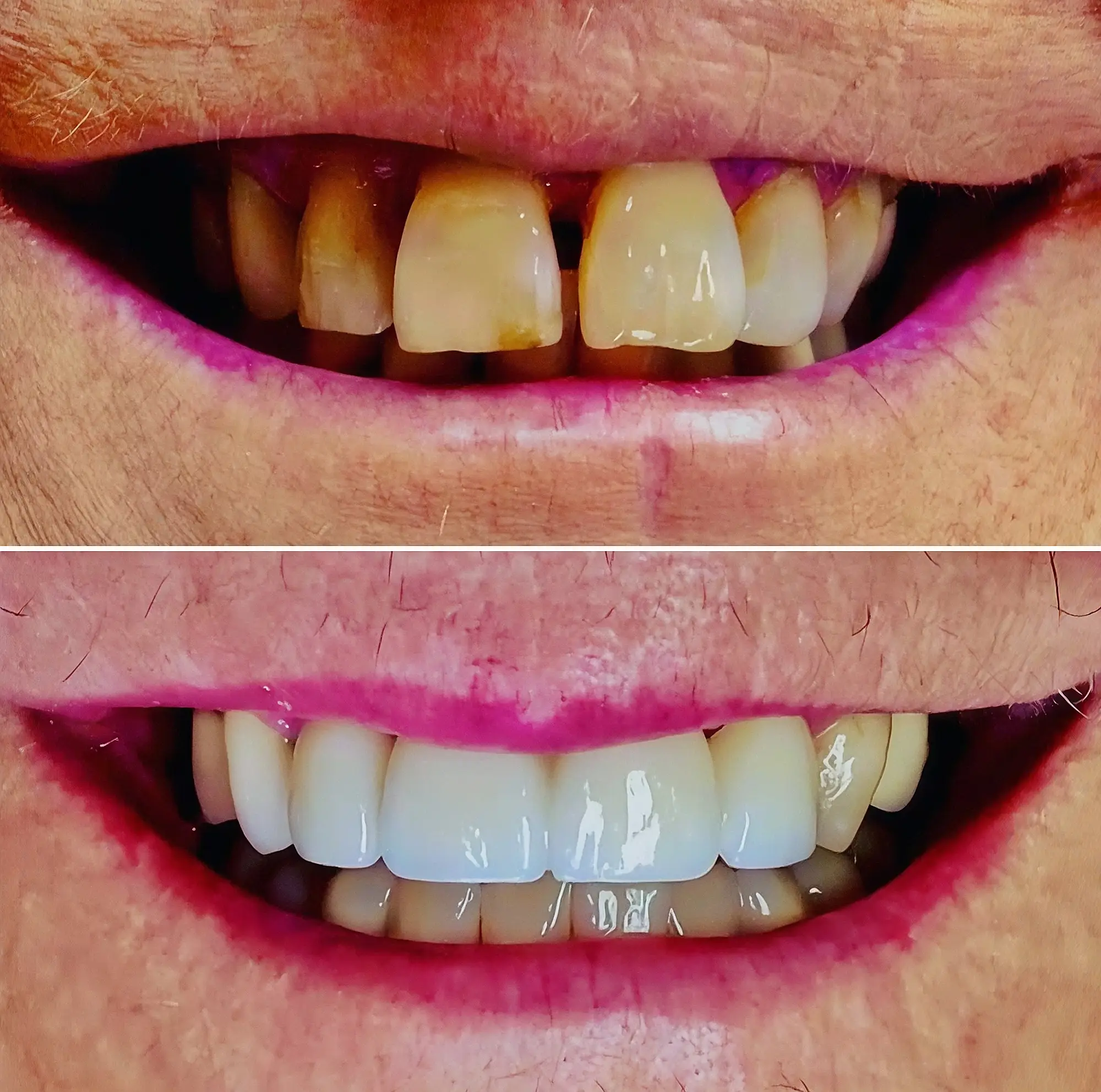 Before and after dental restoration showing brighter, more uniform front teeth.