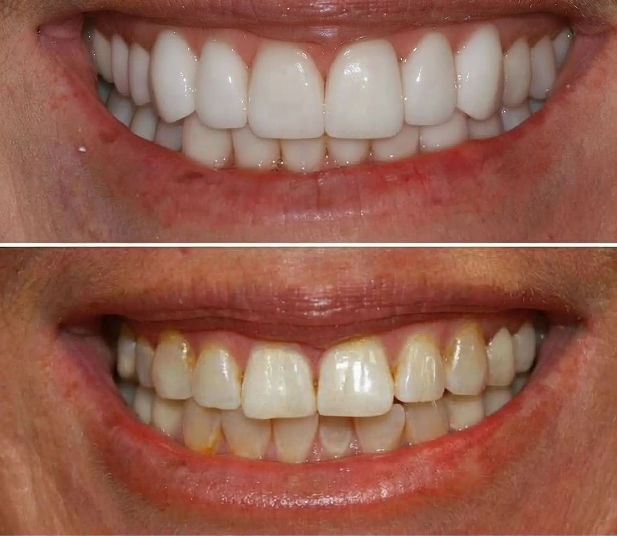 Before and after smile transformation showing improved tooth color.