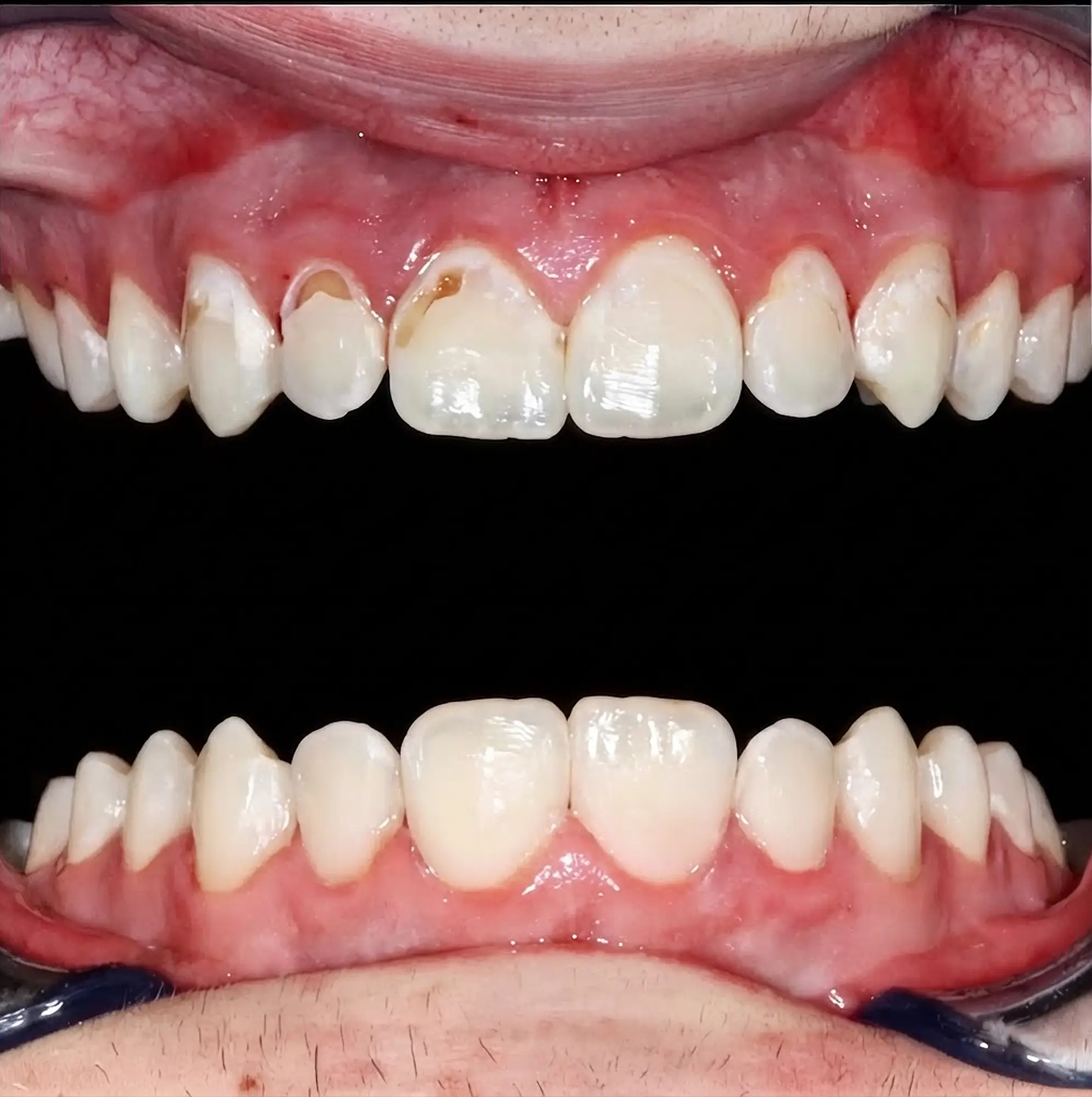 Before and after smile transformation showing restoration of the dental filling