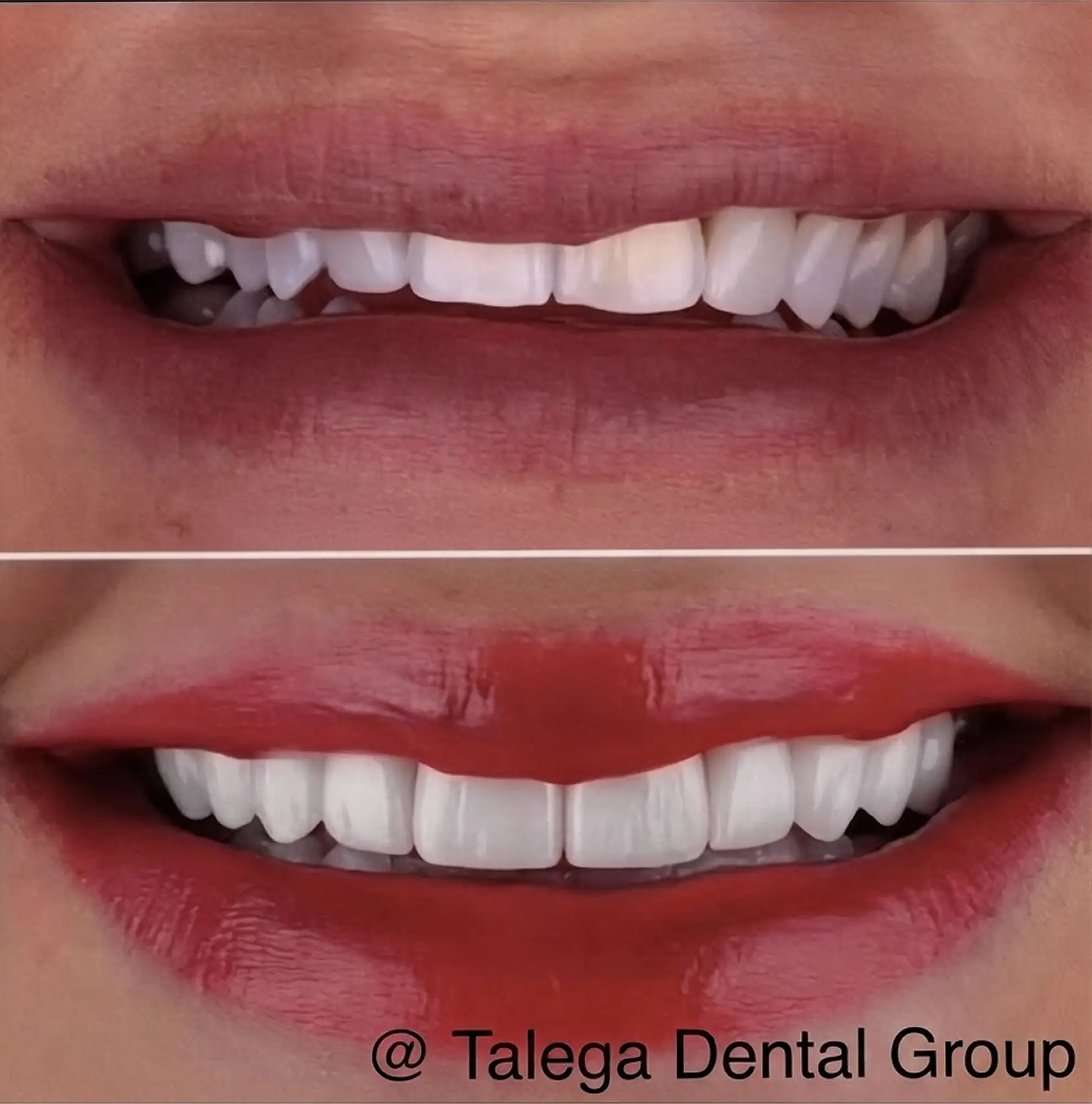 Before and after smile transformation showing improved tooth color and alignment.